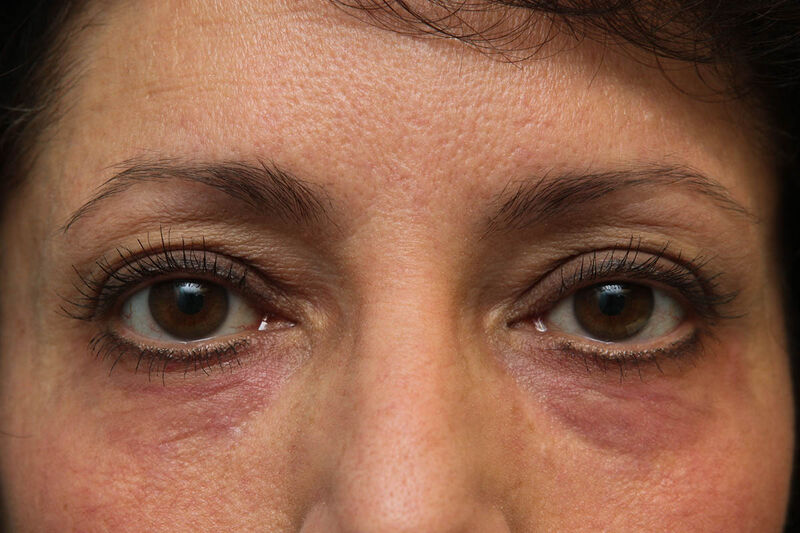 Laser Resurfacing Before & After Patient Photo