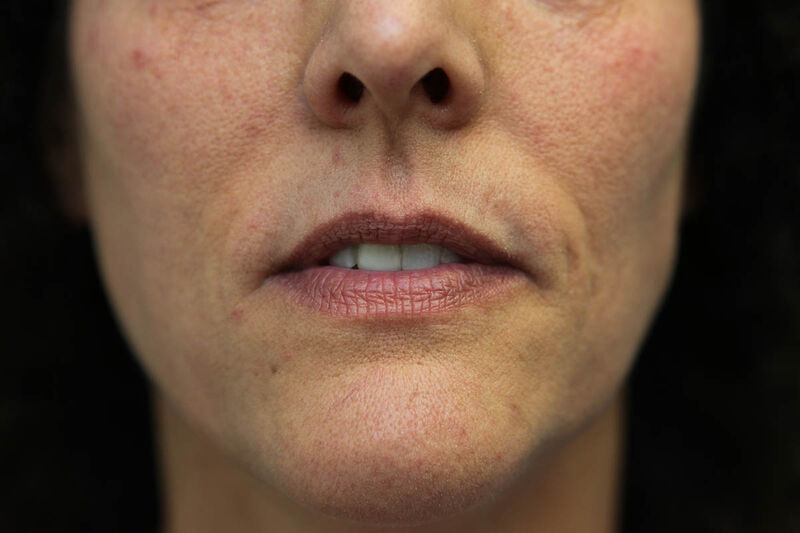 Laser Resurfacing Before & After Patient Photo