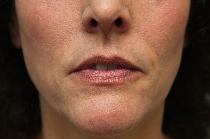 Laser Resurfacing Before & After Patient Photo