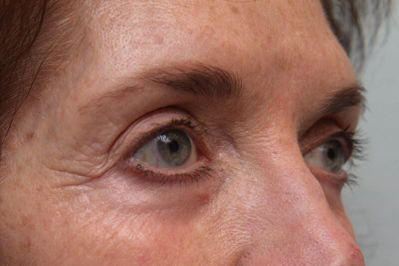 Laser Resurfacing Before & After Patient Photo