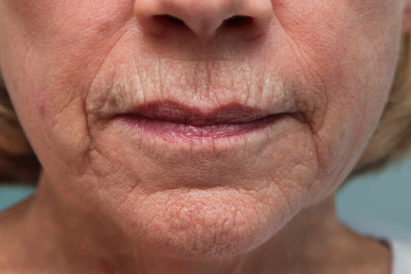 Laser Resurfacing Before & After Patient Photo