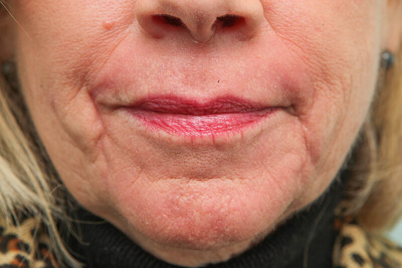 Laser Resurfacing Before & After Patient Photo