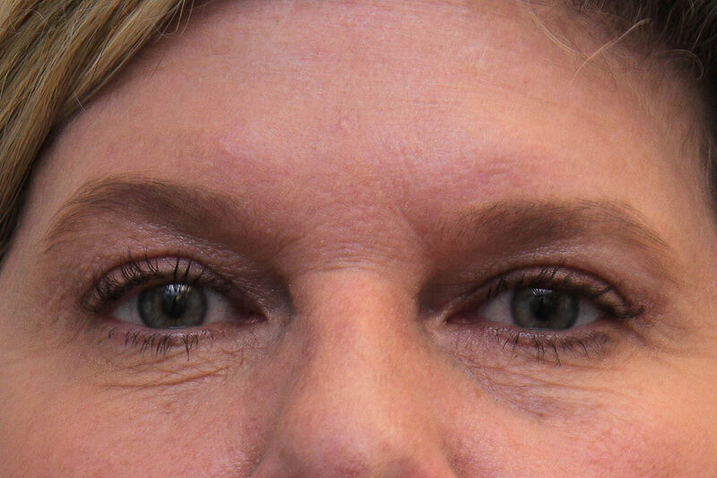 Laser Resurfacing Before & After Patient Photo