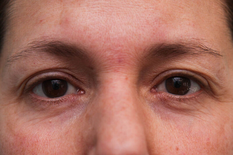 Laser Resurfacing Before & After Patient Photo