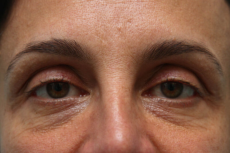 Laser Resurfacing Before & After Patient Photo