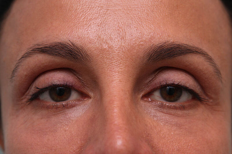 Laser Resurfacing Before & After Patient Photo