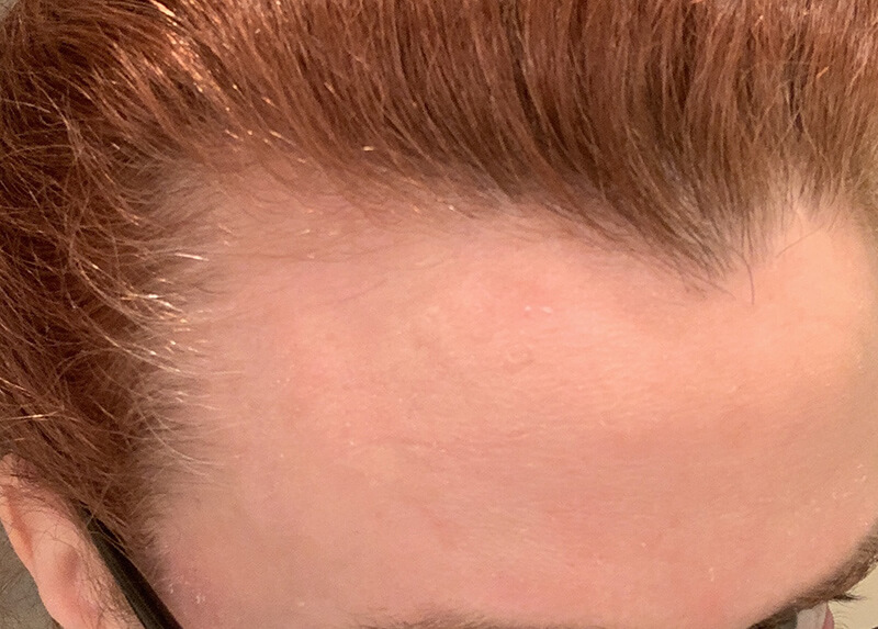 PRP Hair Restoration Before & After Patient Photo