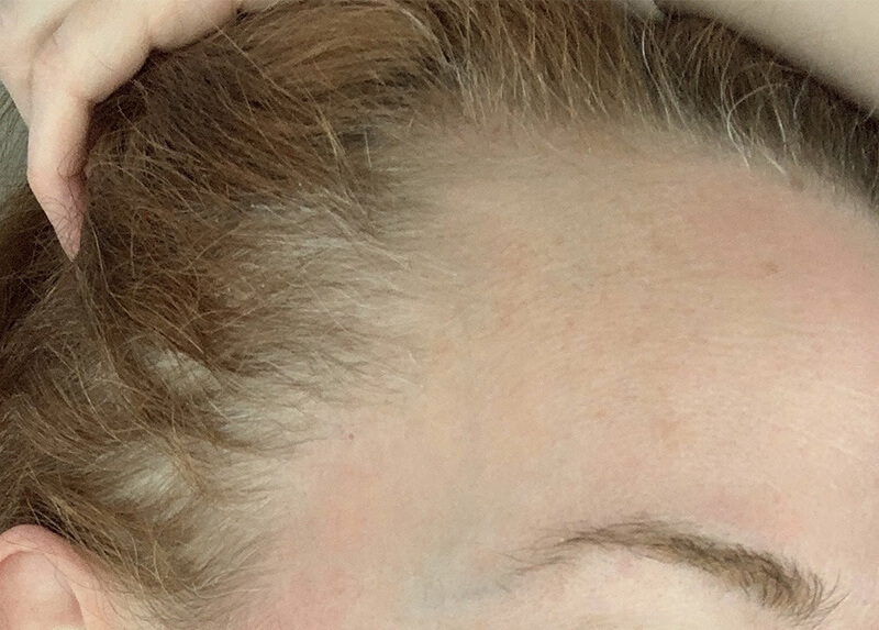 PRP Hair Restoration Before & After Patient Photo