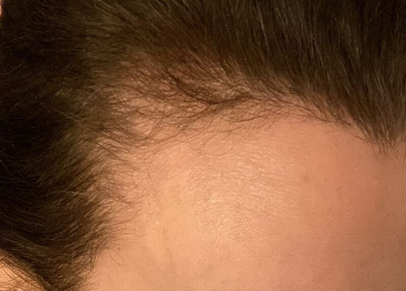 PRP Hair Restoration Before & After Patient Photo