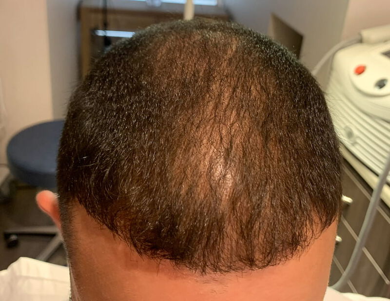 PRP Hair Restoration Before & After Patient Photo