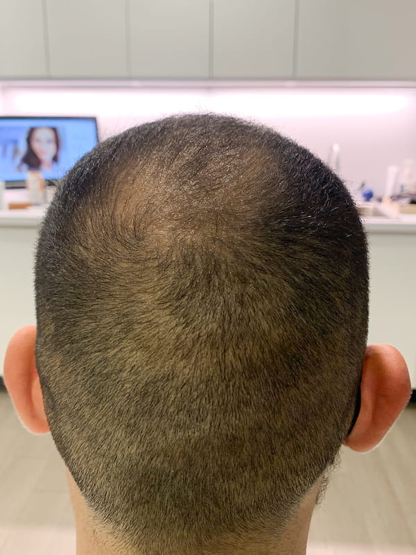 PRP Hair Restoration Before & After Patient Photo