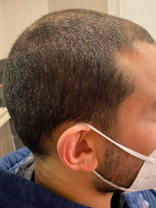 PRP Hair Restoration Before & After Patient Photo