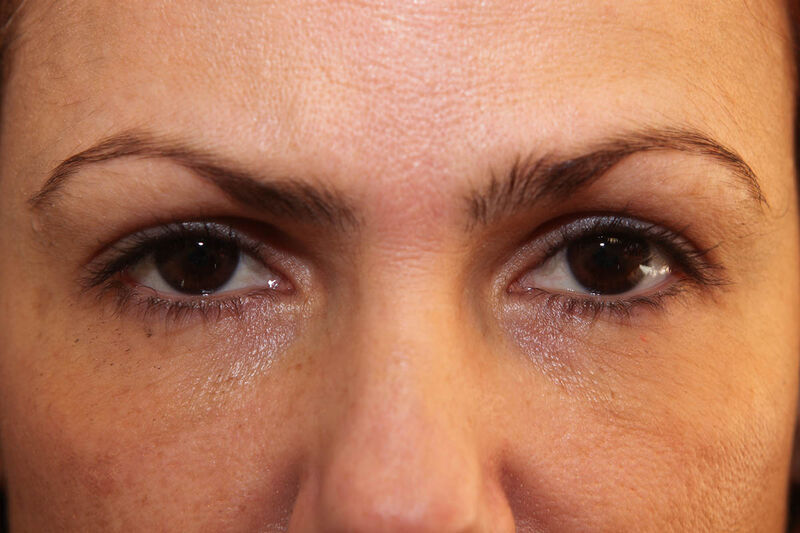 Tear Trough Before & After Patient Photo