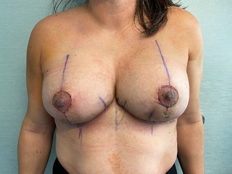 Westport breast reduction patient,front view after surgery