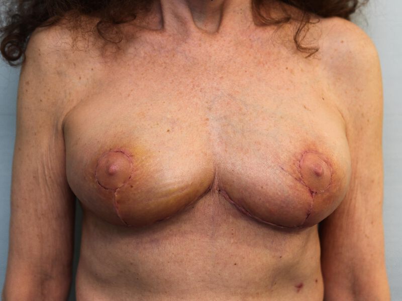 Westport breast reduction patient,front view after surgery