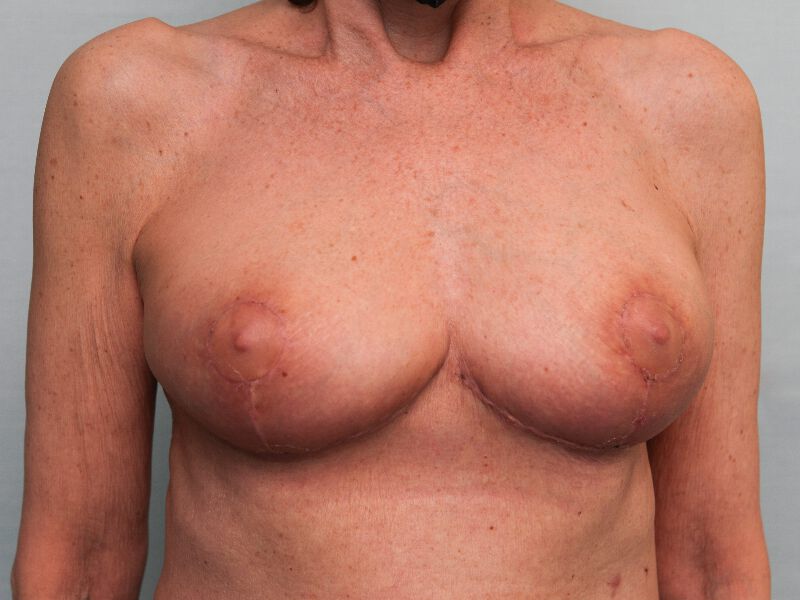 Westport breast reduction patient, front view 2 days after surgery
