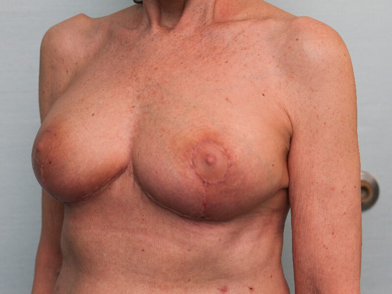 Westport breast reduction patient, left view 2 days after surgery