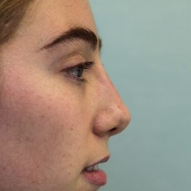 Liquid Rhinoplasty is an non-surgical nose job where injectables/fillers such as BOTOX, Juvederm, Restylane, Perlane and Belotero are injected to achieve the desired result without a scalpel.