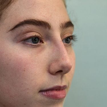 Liquid Rhinoplasty is an non-surgical nose job where injectables/fillers such as BOTOX, Juvederm, Restylane, Perlane and Belotero are injected to achieve the desired result without a scalpel.