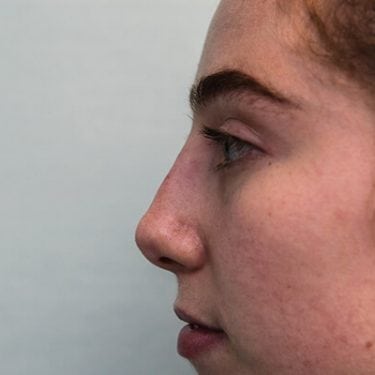Liquid Rhinoplasty is an non-surgical nose job where injectables/fillers such as BOTOX, Juvederm, Restylane, Perlane and Belotero are injected to achieve the desired result without a scalpel.