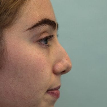 Liquid Rhinoplasty is an non-surgical nose job where injectables/fillers such as BOTOX, Juvederm, Restylane, Perlane and Belotero are injected to achieve the desired result without a scalpel.