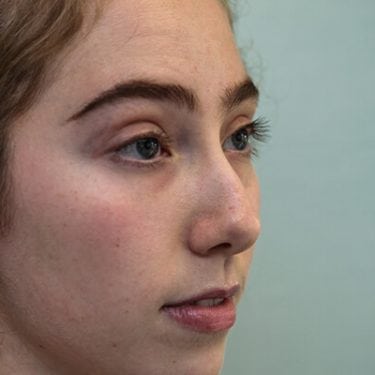 Liquid Rhinoplasty is an non-surgical nose job where injectables/fillers such as BOTOX, Juvederm, Restylane, Perlane and Belotero are injected to achieve the desired result without a scalpel.