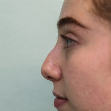 Liquid Rhinoplasty is an non-surgical nose job where injectables/fillers such as BOTOX, Juvederm, Restylane, Perlane and Belotero are injected to achieve the desired result without a scalpel.