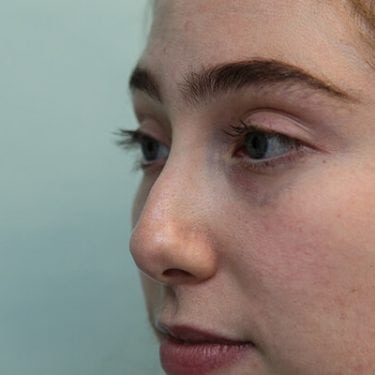 Liquid Rhinoplasty is an non-surgical nose job where injectables/fillers such as BOTOX, Juvederm, Restylane, Perlane and Belotero are injected to achieve the desired result without a scalpel.